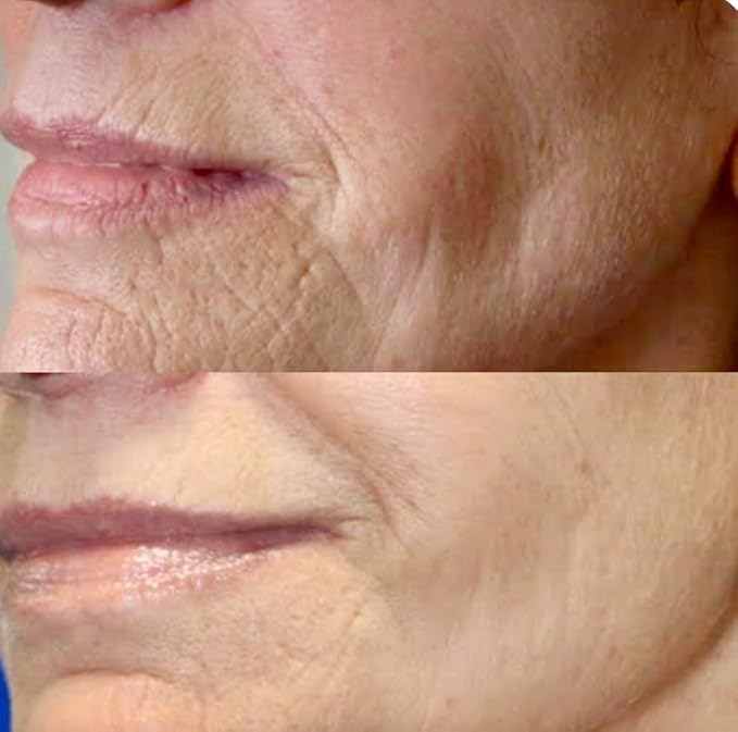 Hyaluronic Acid Moisturizer with Retinol Vit CE Aloe Vera Shea Butter