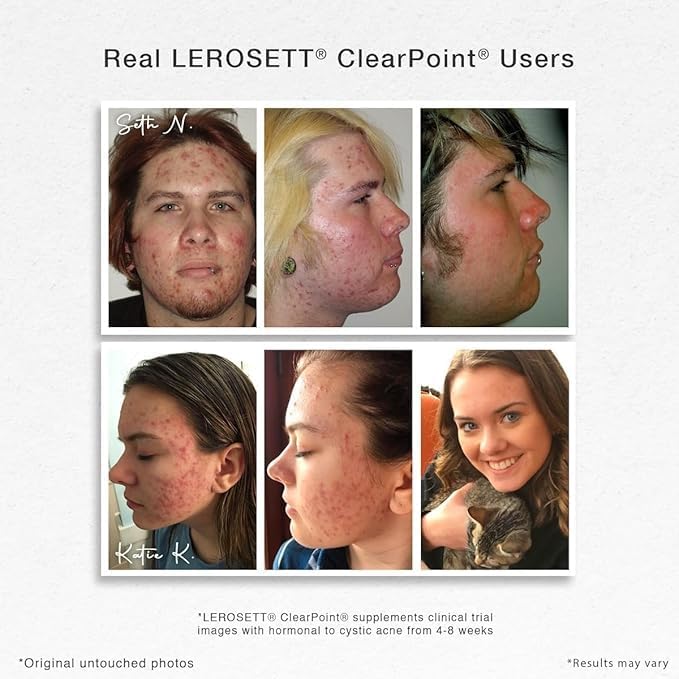 LEROSETT ClearPoint Anti Acne Pills Natural Supplements for Hormonal &amp Cystic Acne Treatment for Oily Skin &amp Breakouts. 60 Caps