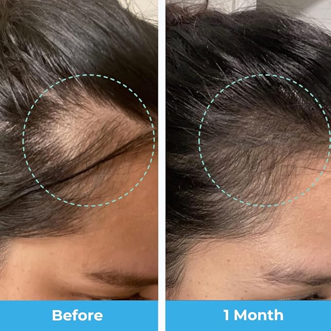 Baby Blues Postpartum Hair Loss Vitamins - Passion Fruit Gummies with Biotin Collagen &amp Folate