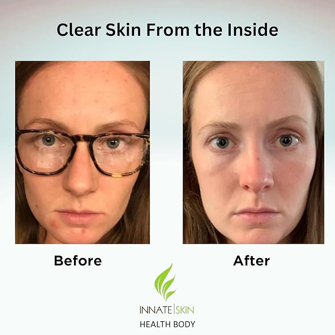 Clear Skin Acne Vitamin System | 20 Antioxidants Botanicals &amp Minerals | 60 Count | Pack of 4 | 240 Total Capsules