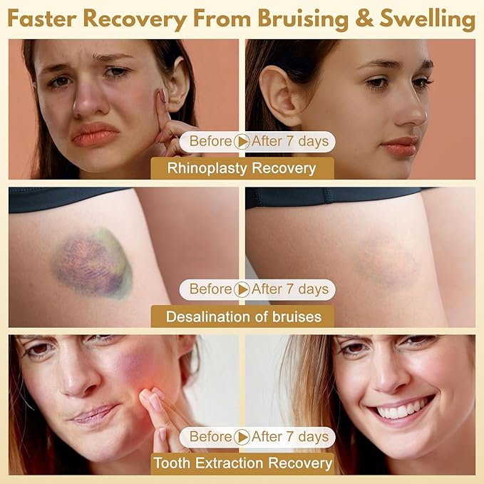 Lunza Aesthetic &amp Surgery Recovery Supplement Swelling and Bruising Relief with Arnica 1000mg &amp Bromelain 125mg 60 Capsules