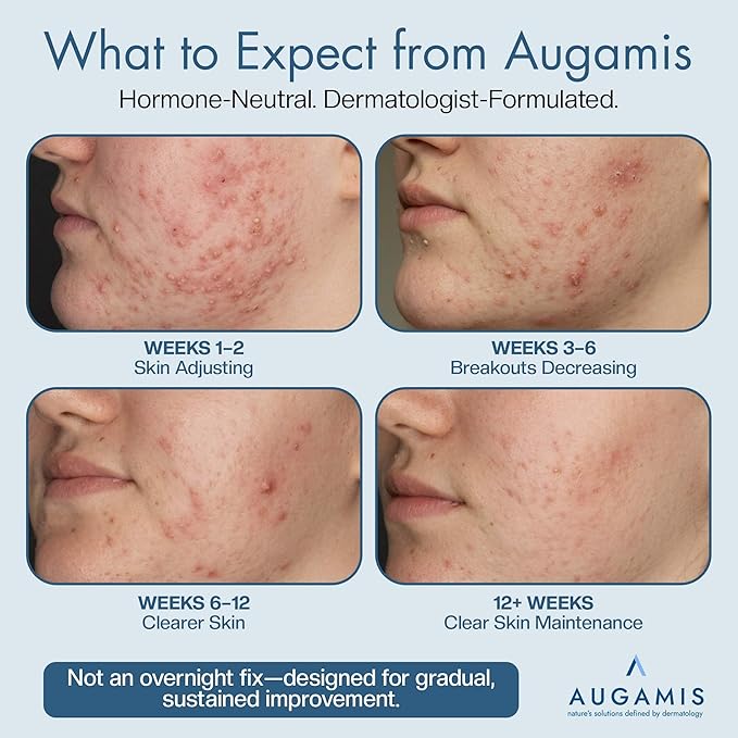 Hormonal Acne Treatment for Women - No DIM - (60 Capsules 485 mg) – DIM-Free Acne Medication - Helps Nodular &amp Hormonal Acne - Best Acne Treatment for Teenagers &amp Adults