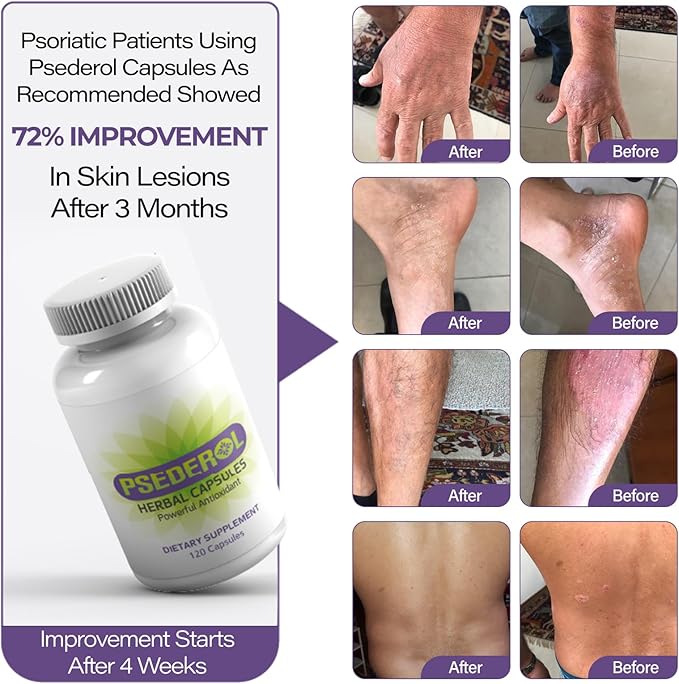 Psoriasis Support for Skin 120 Herbal Capsules Natural Psoriasis Supplements Traditional Indian Ayurveda Medicinal Plants with 6 Antioxidant Herbs Dry and Itchy Skin Supplement