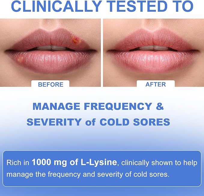 Lysine Cold Sore Treatment for Lips with Probiotics &amp Vitamin C for Lip Skin Gut &amp Immune Health Managing Cold Sore Frequency &amp Severity Cold Sore Patch Alternative 100 Capsules