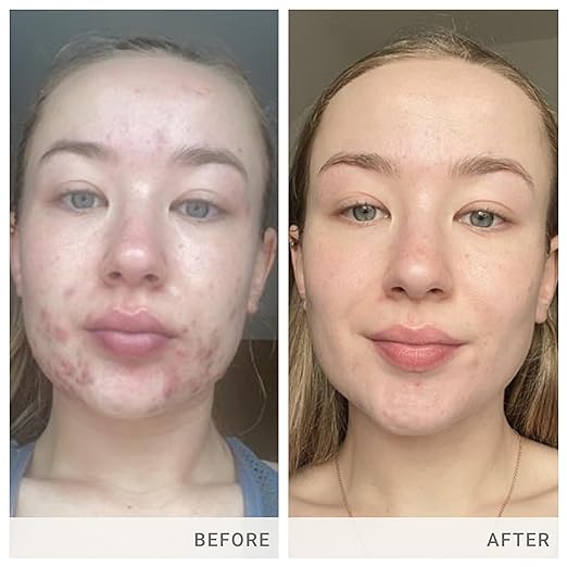 jane iredale Skin Accumax Nutritional Supplement Capsules Improve Acne &amp Promote Healthy Skin Contains Vitamin A C and E Vegan &amp Gluten-Free