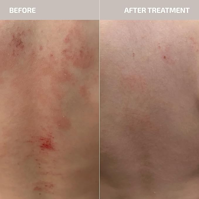Codex Labs ANTÜ Skin Barrier Repair Supplement – Oral Sachets for Eczema Rosacea &amp Psoriasis – Clinically Proven Vegan Dermatologist-Tested – Strawberry Lemonade Flavor – 30-Day Supply