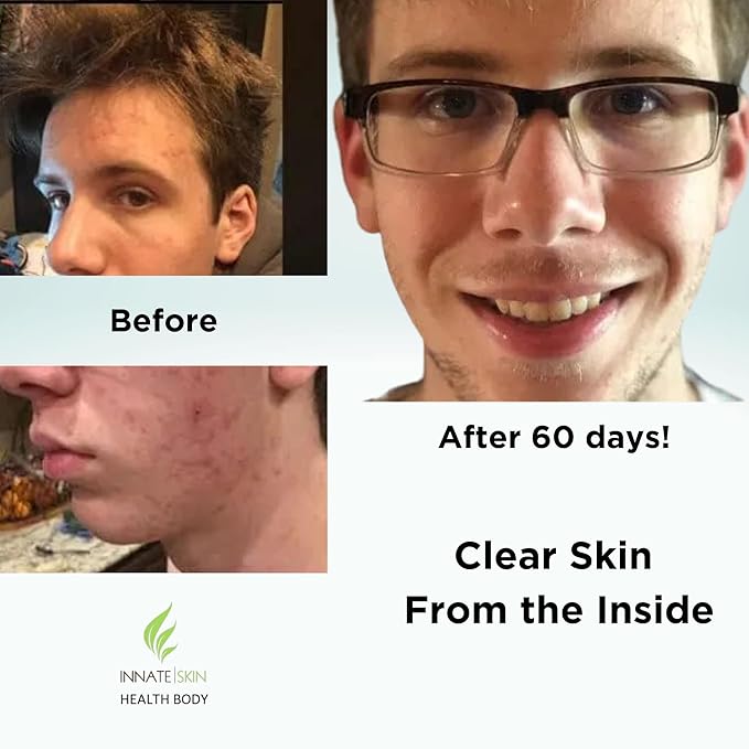 Clear Skin Acne Vitamin System | 20 Antioxidants Botanicals &amp Minerals | Capsules | 60 Count | Pack of 2