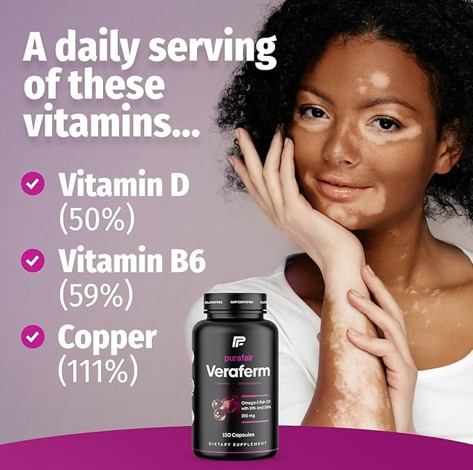 Vitiligo? Improve Skin Pigmentation &amp Get Rid of White Spots on Skin with This Vitiligo Treatment: Veraferm. These Vitiligo Pills Can Be Used Alone or with Vitiligo Creams for Best Results.