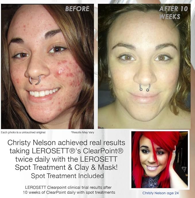 LEROSETT ClearPoint Anti Acne Pills Natural Supplements for Hormonal &amp Cystic Acne Treatment for Oily Skin &amp Breakouts. 60 Caps