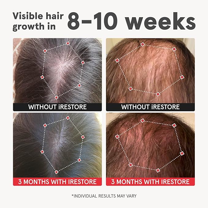 iRestore Advanced Hair Growth Supplement for Women Hair Vitamins for Faster Hair Regrowth Best for Hair Loss and Thinning - 1 Month Supply Each - 1 Count (Pack of 2) - Black