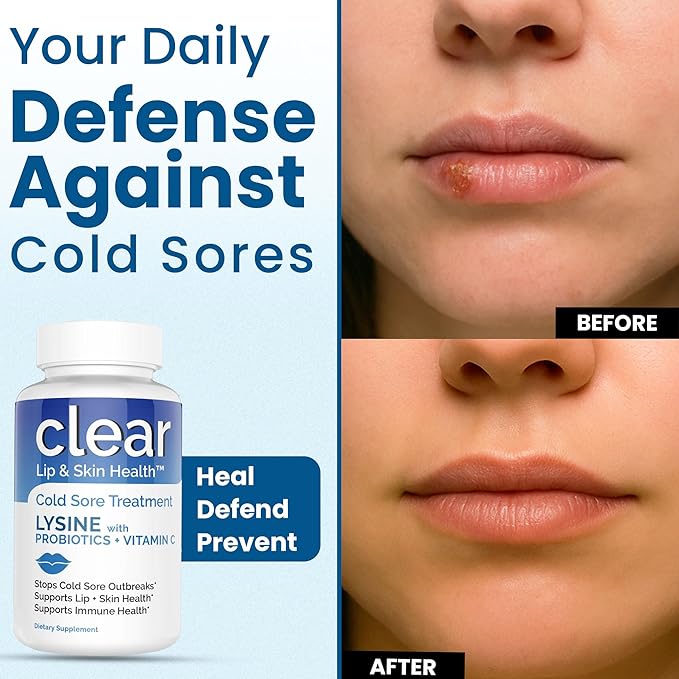 Lysine Cold Sore Treatment for Lips – with Lactobacillus Rhamnosus Acidophilus and Vitamin C – Cold Sore Supplement for Lip &amp Skin Health Immune Support &amp Prevention – 360 Capsules