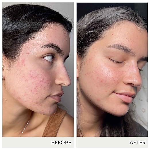 jane iredale Skin Accumax Nutritional Supplement Capsules Improve Acne &amp Promote Healthy Skin Contains Vitamin A C and E Vegan &amp Gluten-Free