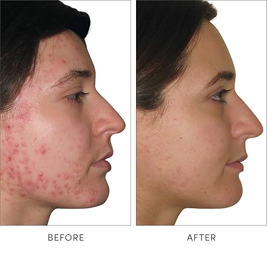 jane iredale Skin Accumax Nutritional Supplement Capsules Improve Acne &amp Promote Healthy Skin Contains Vitamin A C and E Vegan &amp Gluten-Free